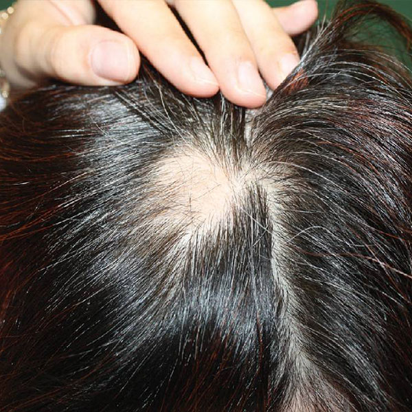 داء الثعلبة Alopecia Areata (AA)