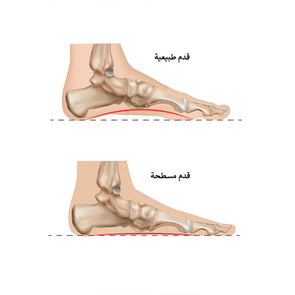 القدم المسطحة (Flat feet)