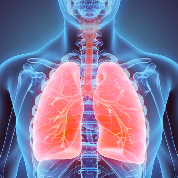 توسع الشعب الهوائية (Bronchiectasis)