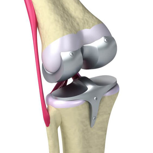 زراعة مفصل الركبة (Knee replacement)