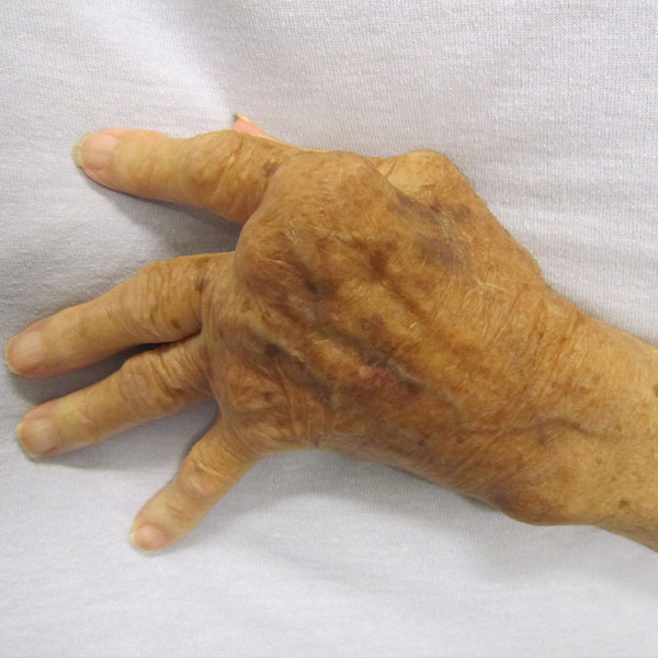 مرض الروماتويد (Rheumatoid arthritis)